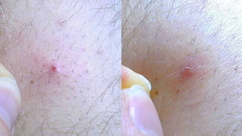 Hình ảnh cận cảnh lông mọc ngược trên da, một người đang dùng tay xử lý khu vực này.