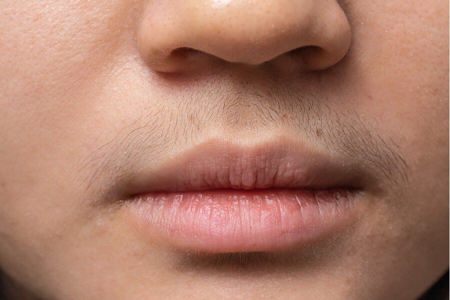 Cận cảnh vùng da quanh miệng và mũi, với lông măng mọc lưa thưa trên môi trên.