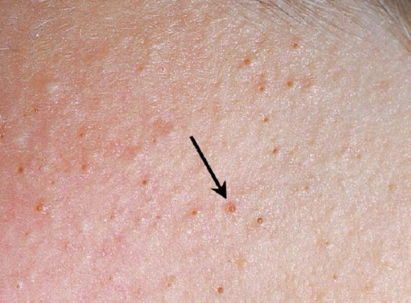 Lông Mọc Ngược Vùng Kín: Nguyên Nhân Và Cách Khắc Phục Hiệu Quả 1 Da mặt với mụn nhỏ và lỗ chân lông, có mũi tên chỉ vào một điểm nổi bật.