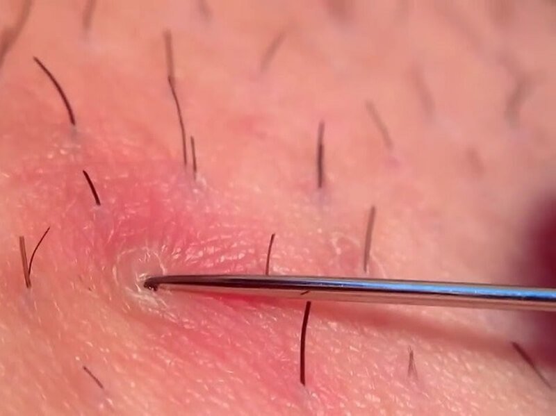 Lông Mọc Ngược Vùng Kín: Nguyên Nhân Và Giải Pháp Khắc Phục Hiệu Quả 3 Hình ảnh chi tiết về da với các lỗ chân lông, sợi lông và nhíp kim loại đang chạm vào bề mặt da.