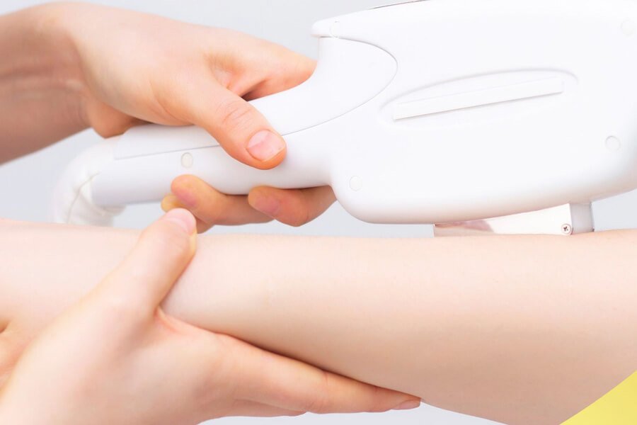 Tay cầm thiết bị laser đang áp lên cánh tay của một người trong quá trình điều trị hoặc chăm sóc da.