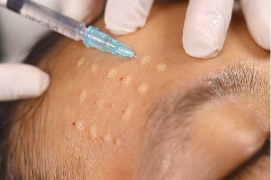 Bác sĩ đang tiêm chất lỏng lên da đầu của một người, có nhiều dấu chấm nhỏ trên bề mặt da.
