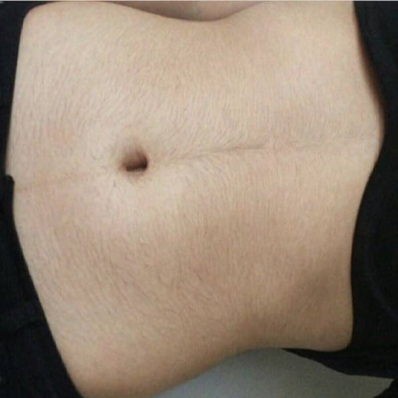 Bụng người với rốn, da có lông mịn và vết thâm nhẹ, mặc quần tối màu.